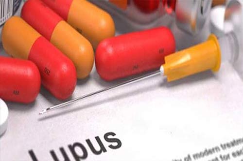 Tanda Dan Gejala Penyakit Lupus