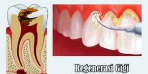 Terapi Regenerasi Gigi