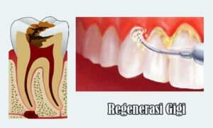Terapi Regenerasi Gigi