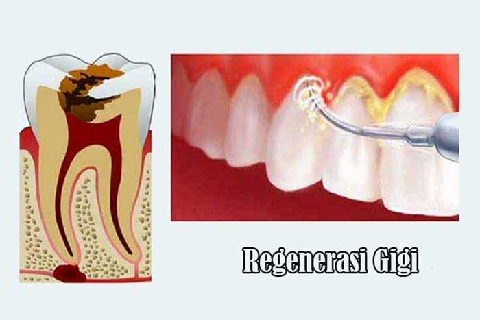 Terapi Regenerasi Gigi