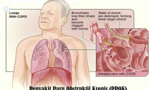 Penyakit Paru Obstruktif Kronis (PPOK)