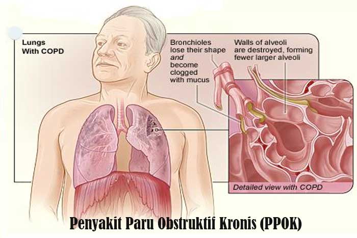 Penyakit Paru Obstruktif Kronis (PPOK)