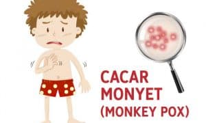 Penyakit cacar monyet (Monkey Pox)