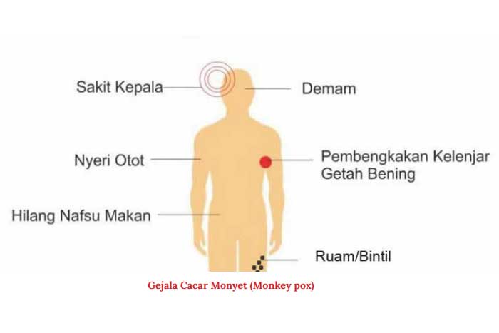 Gejala Cacar Monyet