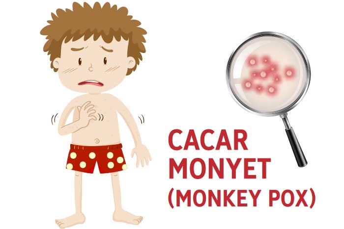 Penyakit cacar monyet (Monkey Pox)
