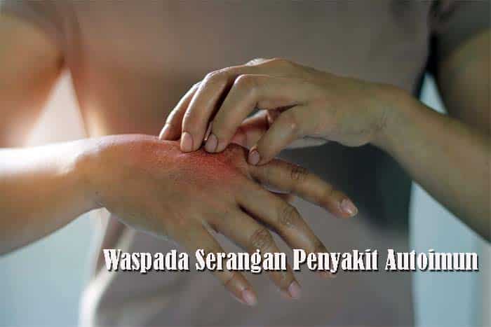 Waspada Serangan Penyakit Autoimun