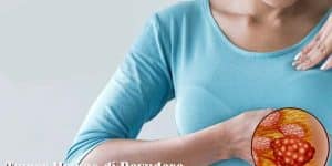 tumor mamae di payudara wanita