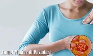 tumor mamae di payudara wanita