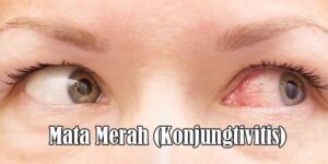 Mata Merah (Konjungtivitis)