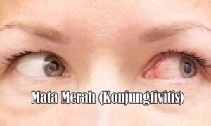 Mata Merah (Konjungtivitis)